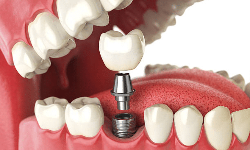 Dental Implant Surgery Needed