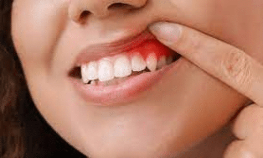 Everything You Need To Know About Gum Disease, The Prevention & Treatment