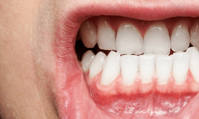 5 Signs You May Have Gum Disease