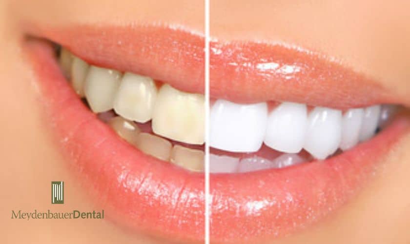 Best Ways To Whiten Teeth Fast