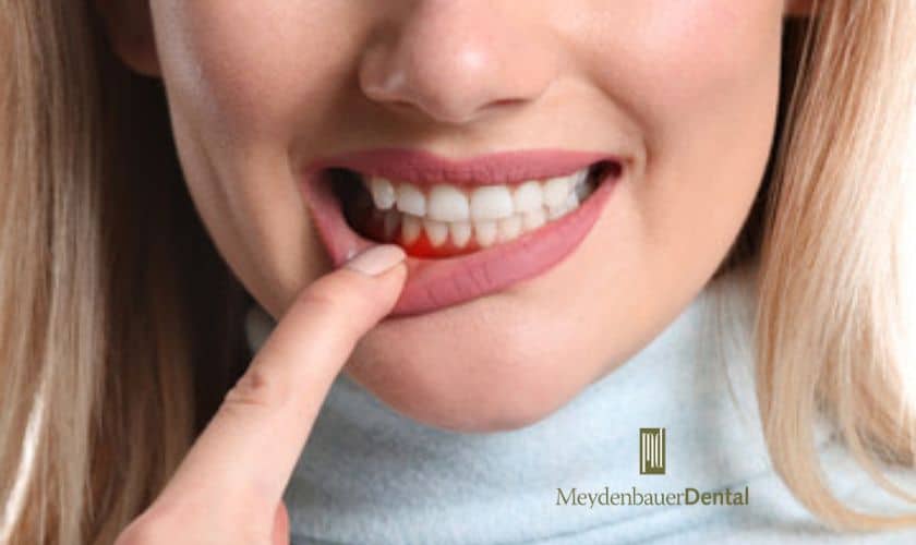 Warning Signs of Gum Disease
