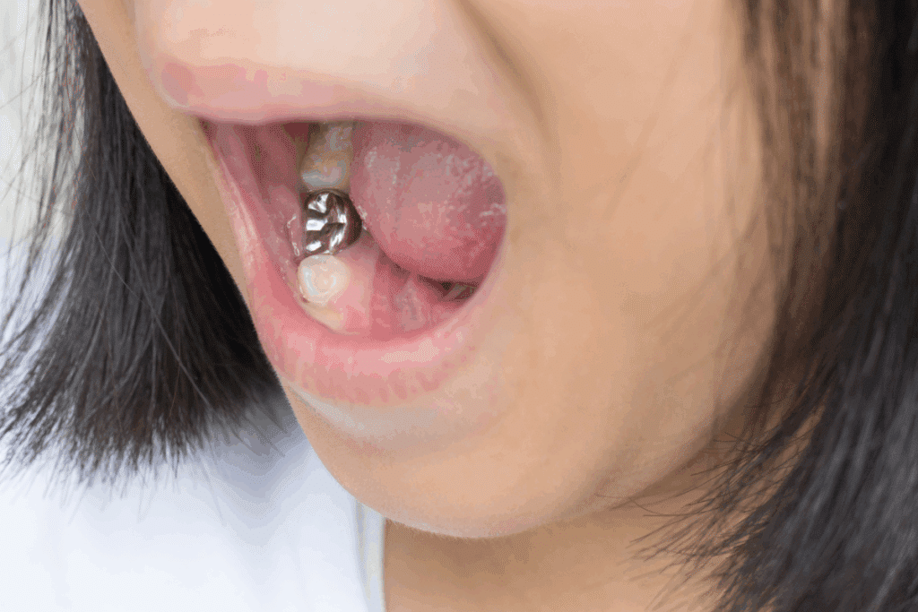 5 Reasons To Get Dental Sealants For Your Teeth Now