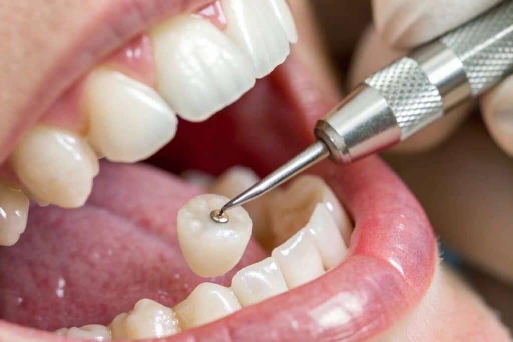 Tips For Affordable Dental Crown Procedures