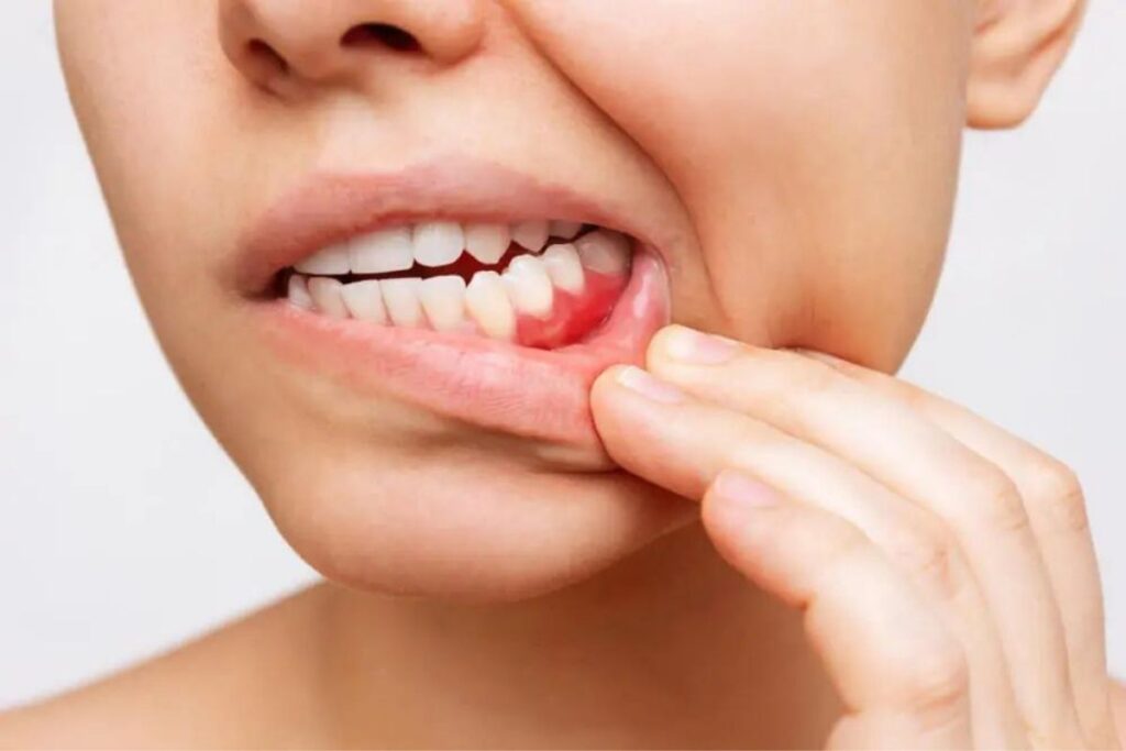 causes gum disease