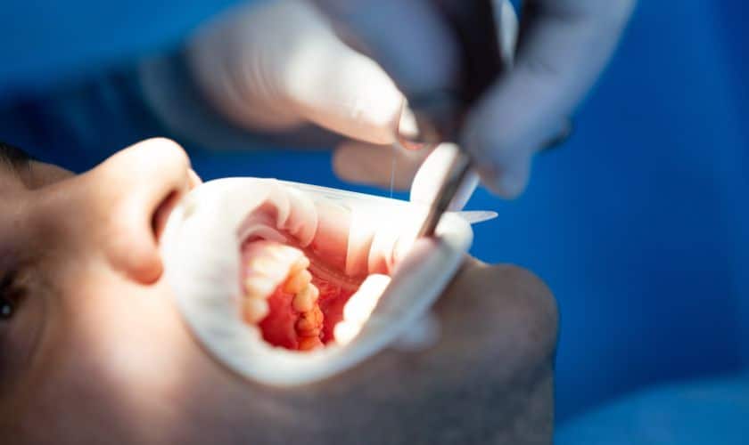 Dental Sealants: Protecting Your Teeth From Decay