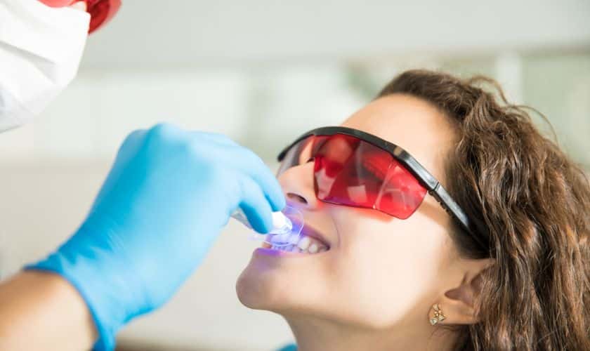 Tooth-colored fillings