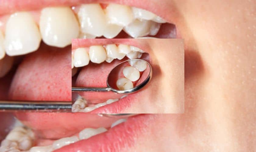 Dental Sealants for Optimal Oral Health