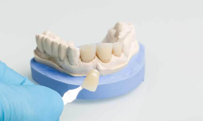 Dental Crowns