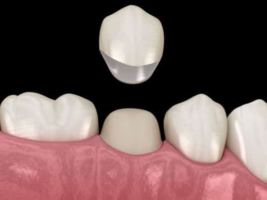 Dental-crown