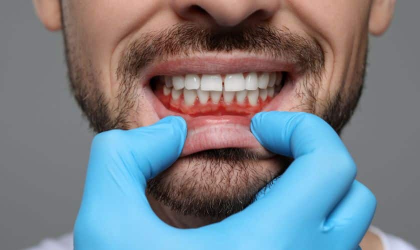 Gum Disease
