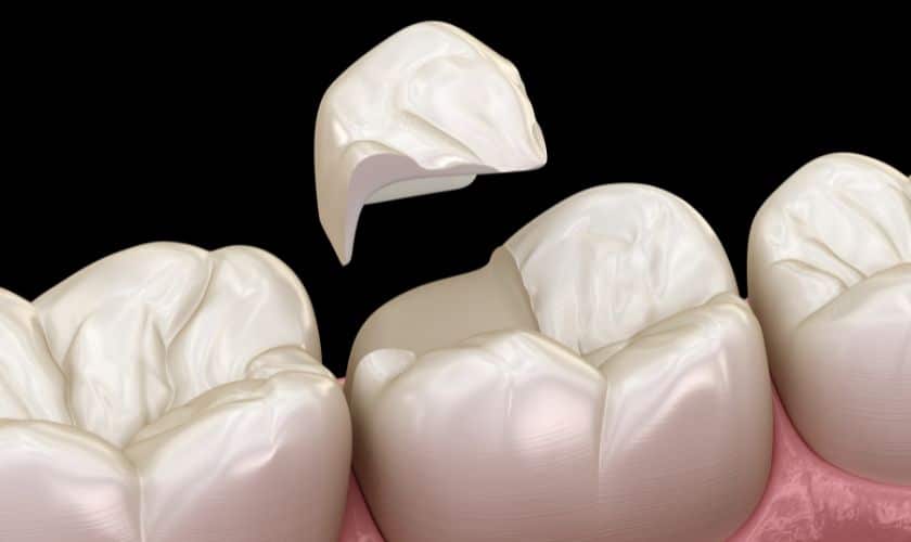 Cracked Tooth