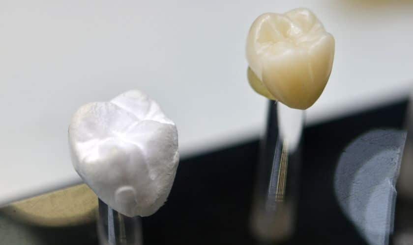 Questions About Dental Crowns