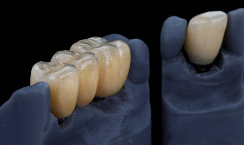 dental crowns in Bellevue