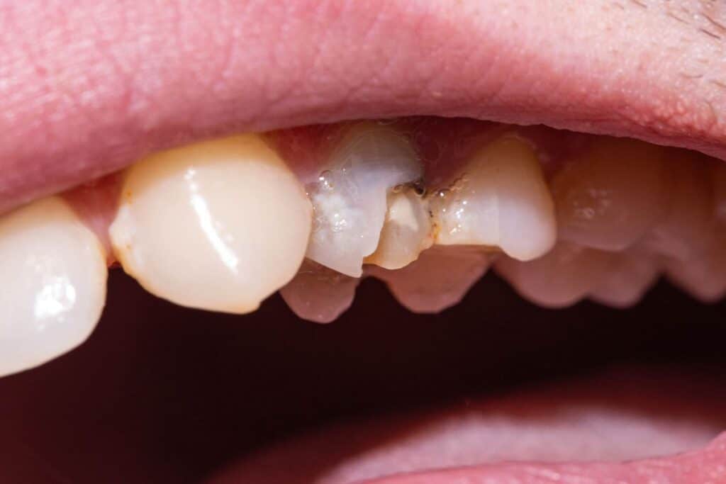Repair a Chipped Tooth