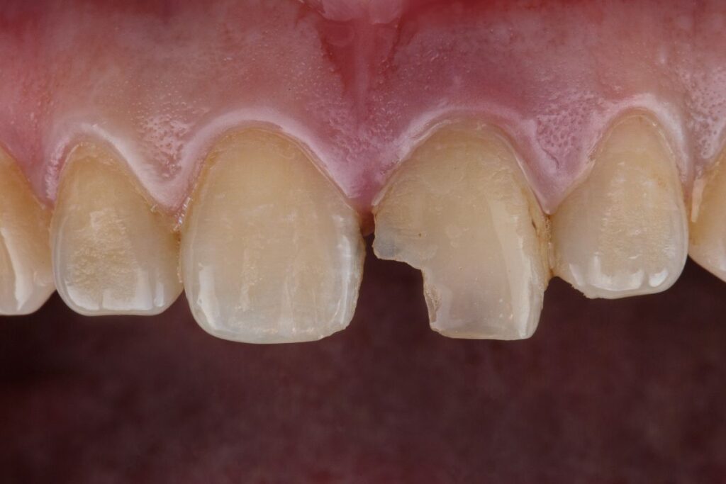 Treat a Chipped Tooth