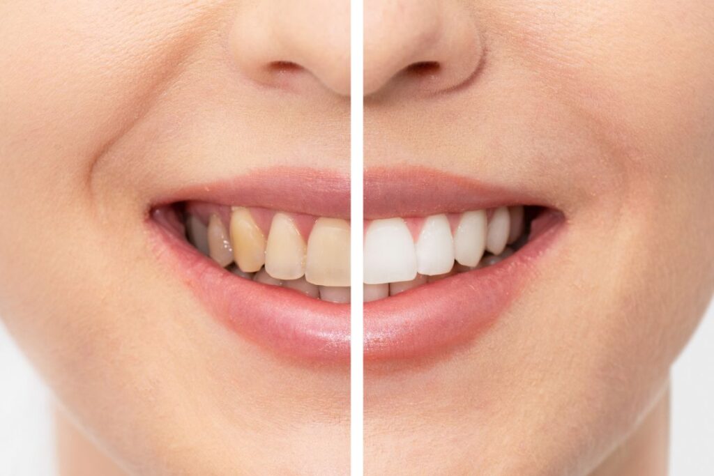 Yellow Teeth Become White Again