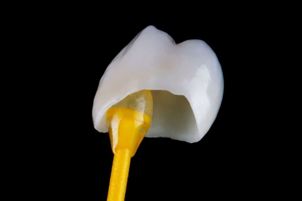 Get Affordable Dental Crowns