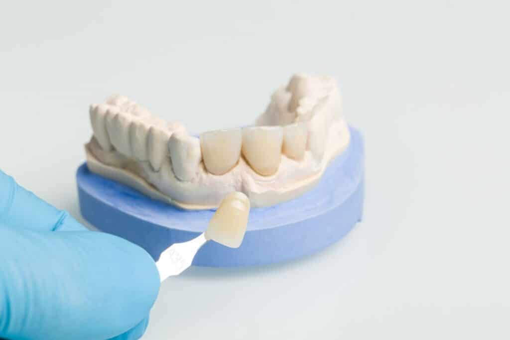 Teeth Under Veneers