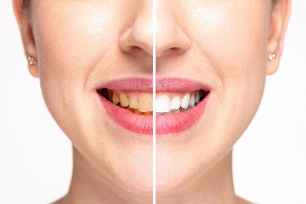 teeth whitening treatment