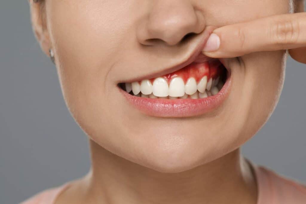 Cosmetic Dentistry Fixes Receding Gums