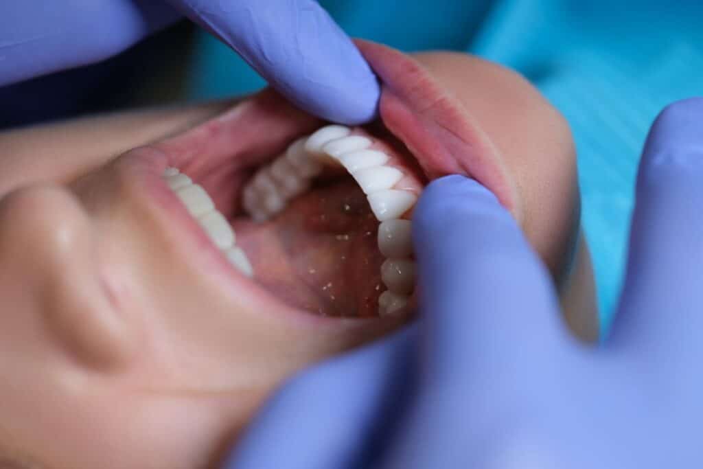 if You Have a Cavity Treatment