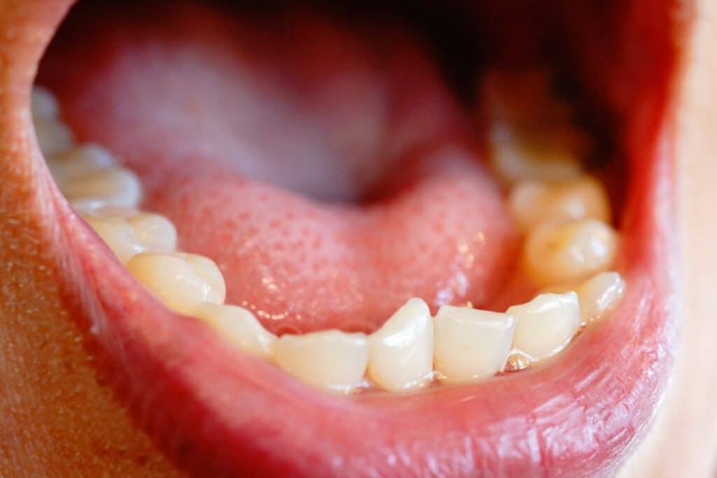 Crooked Teeth fixed by cosmetic dentist