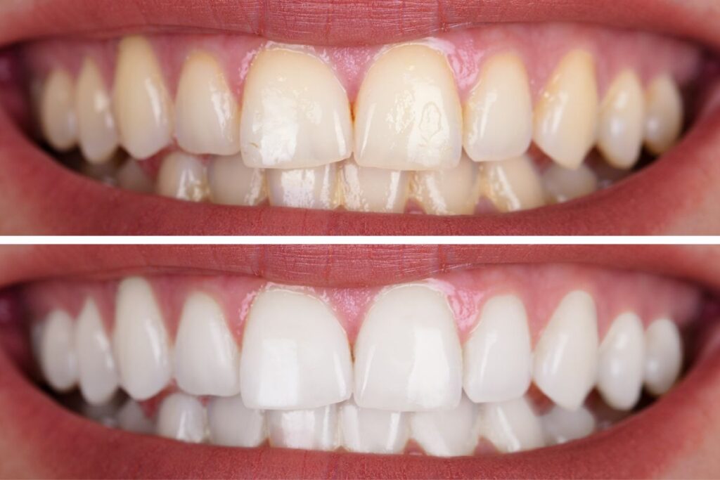 Drink Coffee and Wine After Teeth Whitening