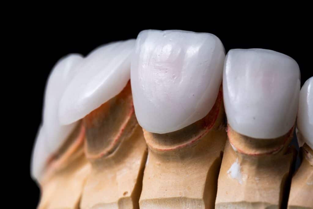 porcelain veneers in Bellevue