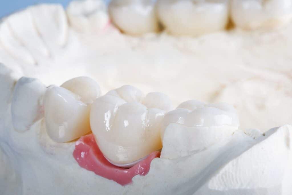 Fix Gap Between Crown and Gum