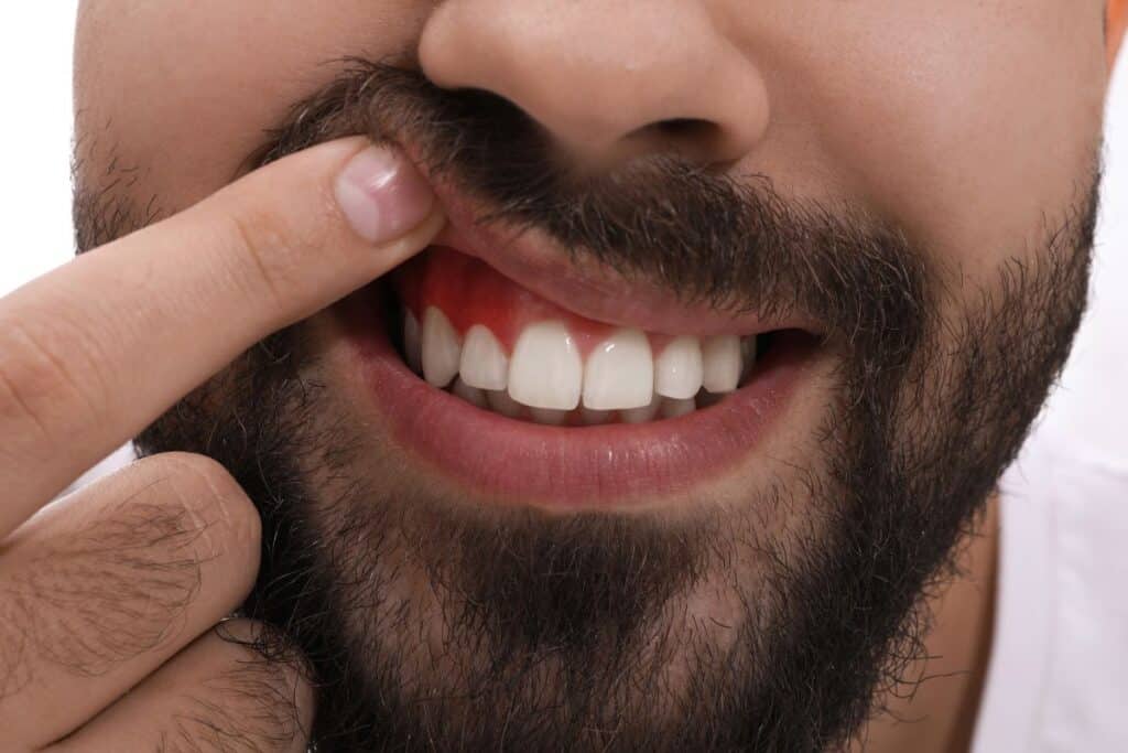 Causes of Bleeding Gums and Gum Disease Treatment