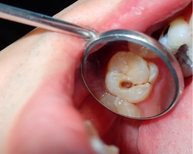 Tooth Decay service