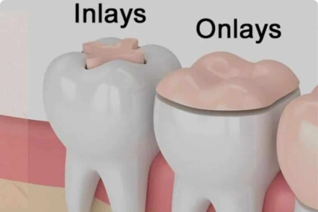 Inlays & Onlays