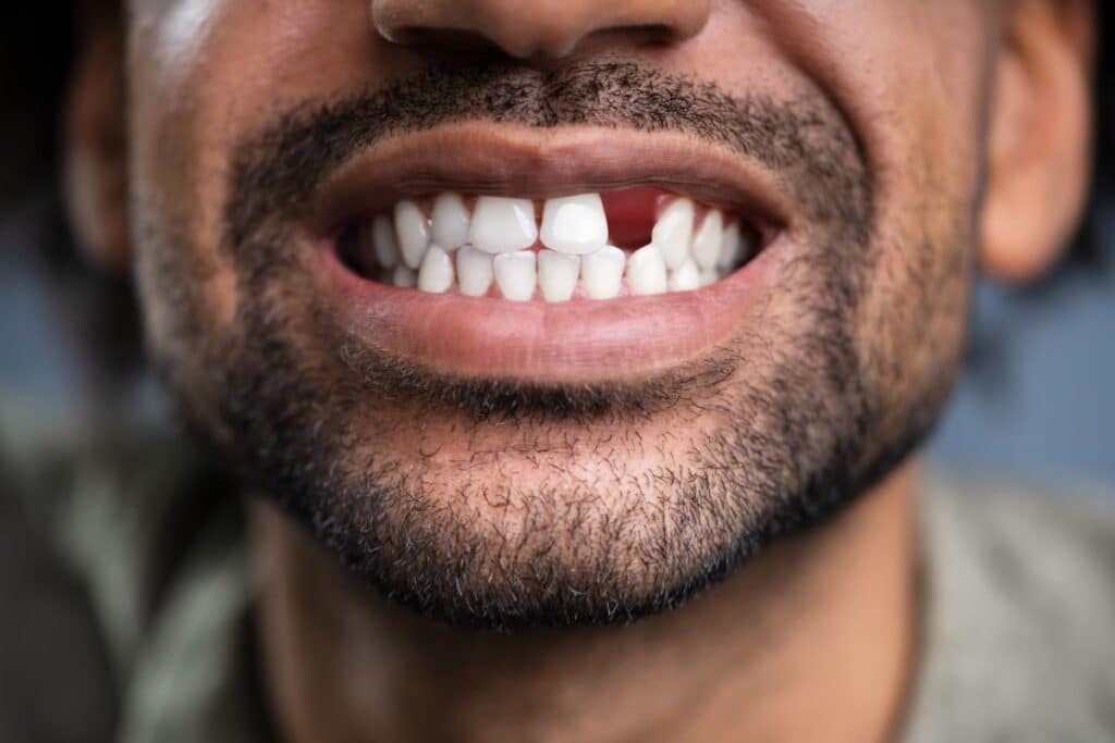 front tooth implants offer a life-changing solution