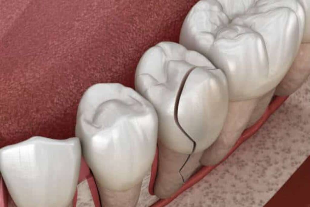 Fixing Gaps, Chips, and Cracks teeth