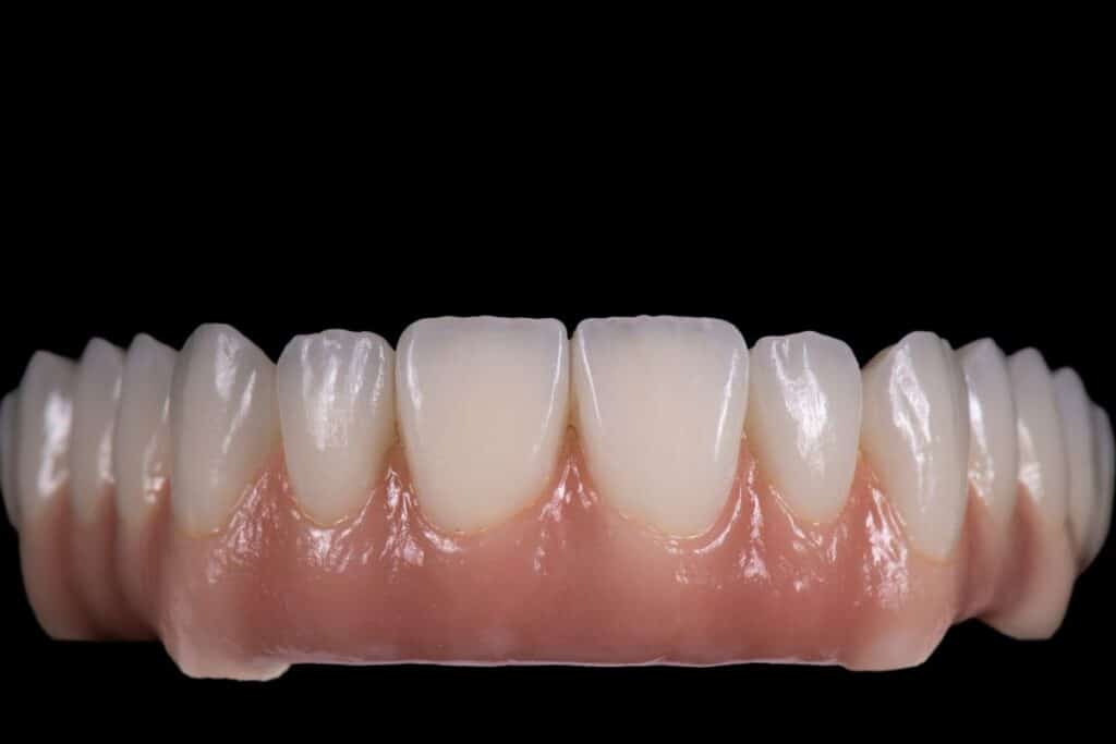 Full Mouth Replacement