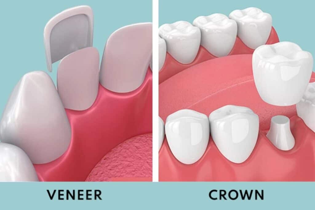 Both crowns and veneers are excellent dental treatments