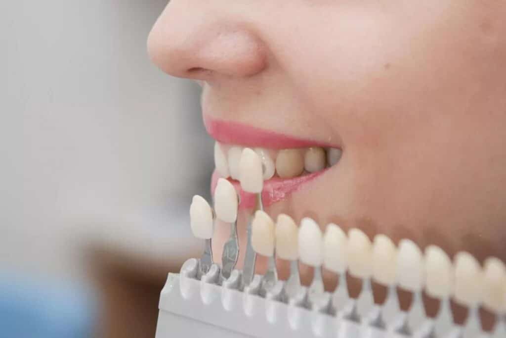 Porcelain Veneers Last on Front Teeth