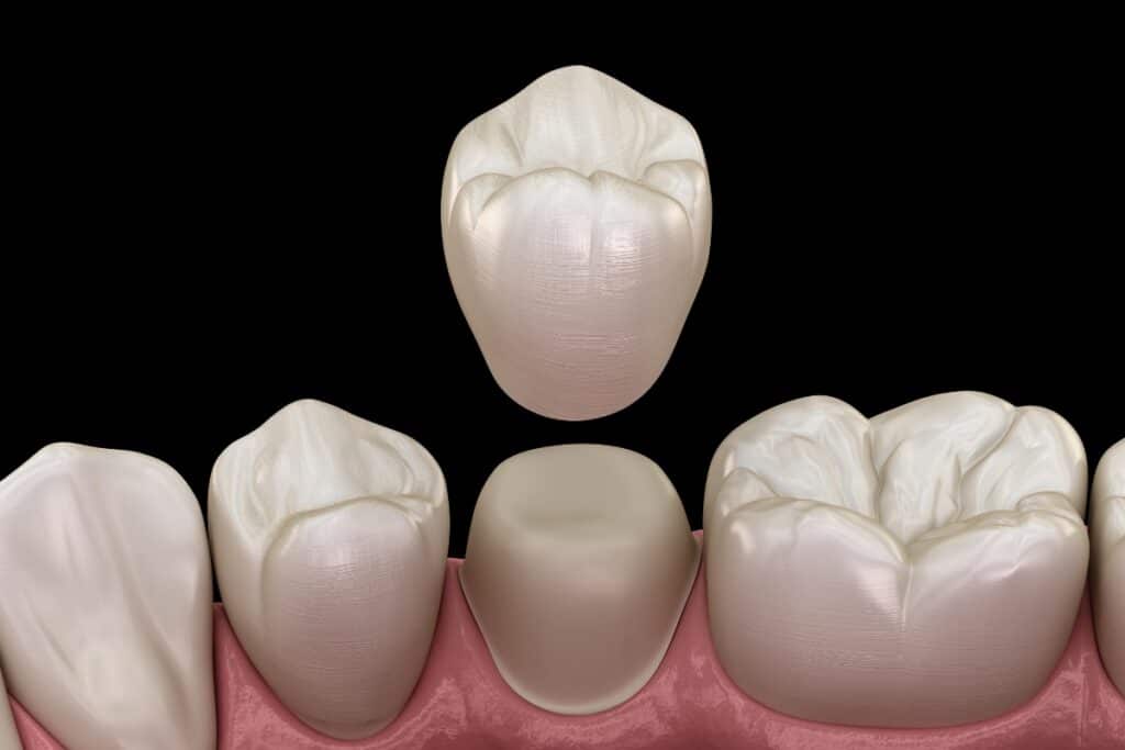 What is the Cause of Dental Crowns Falling Out?