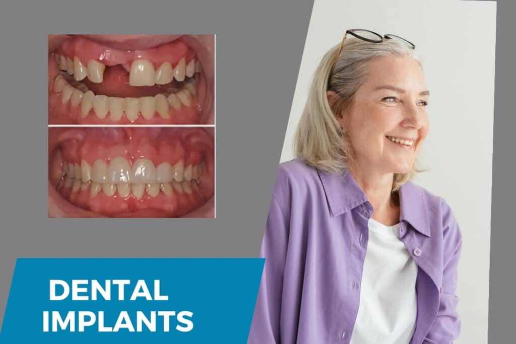 how long after dental implants can I eat normally