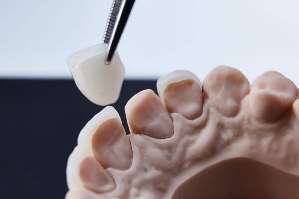 Veneers: Why Some Dentists Prefer Conservative Treatments