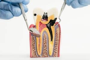 How to Keep Your Dental Pulp Healthy: Prevention Tips from Your Dentist