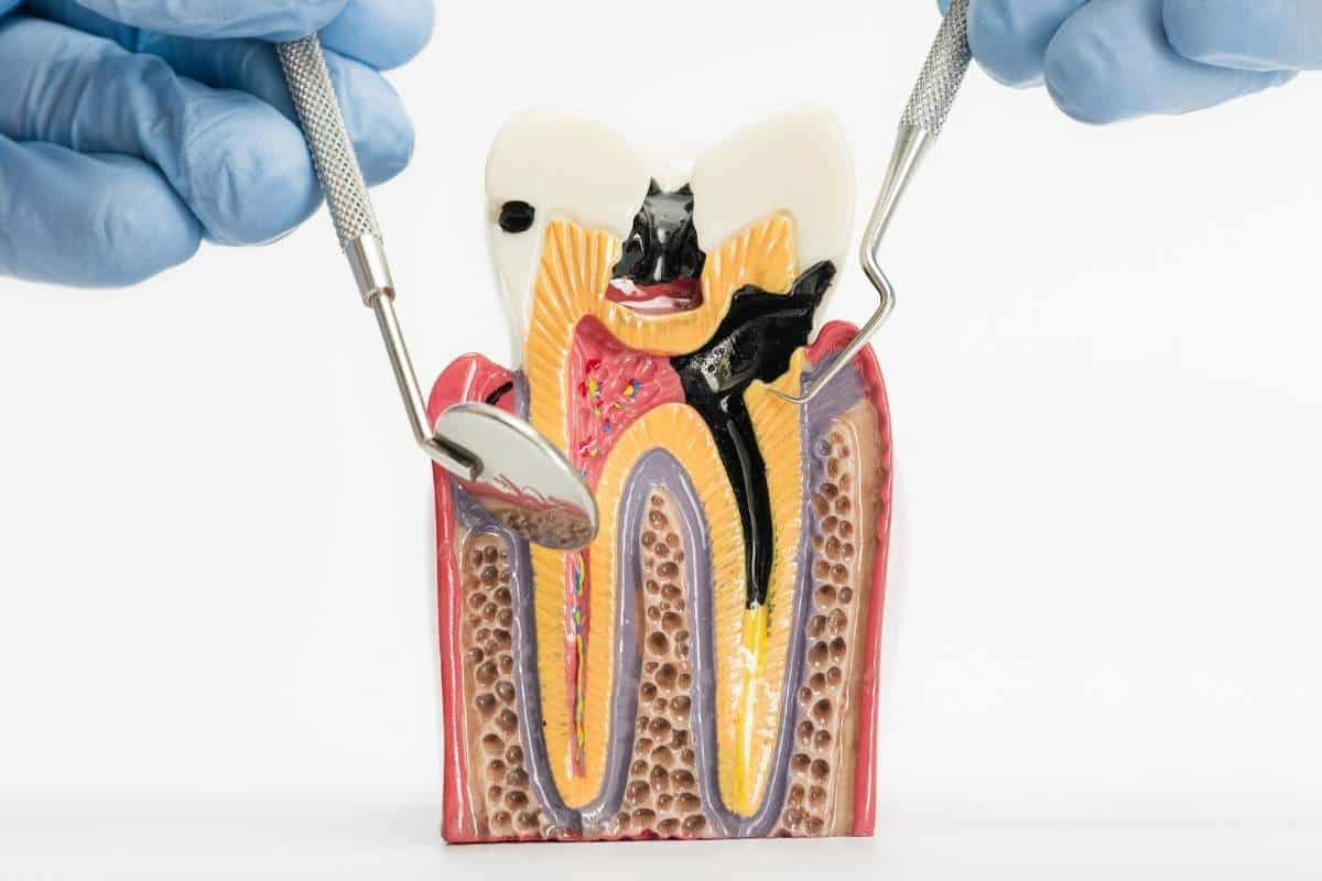 How to Keep Your Dental Pulp Healthy: Tips Dentist