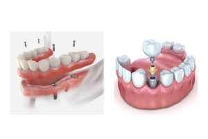 Single Tooth vs Full Arch Implants