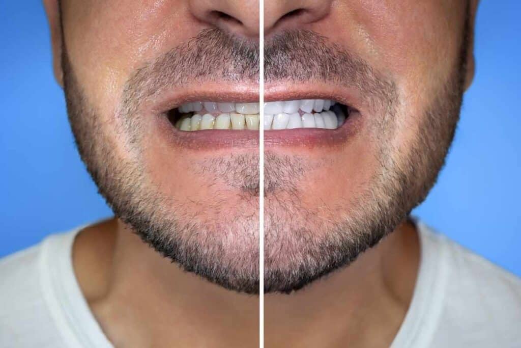 Top 7 Reasons to Choose Professional Teeth Whitening