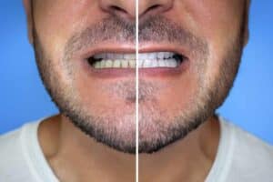 Top 7 Reasons to Choose Professional Teeth Whitening