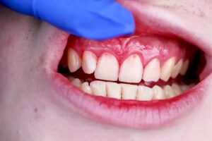 Why Do Gums Bleed When Flossing
