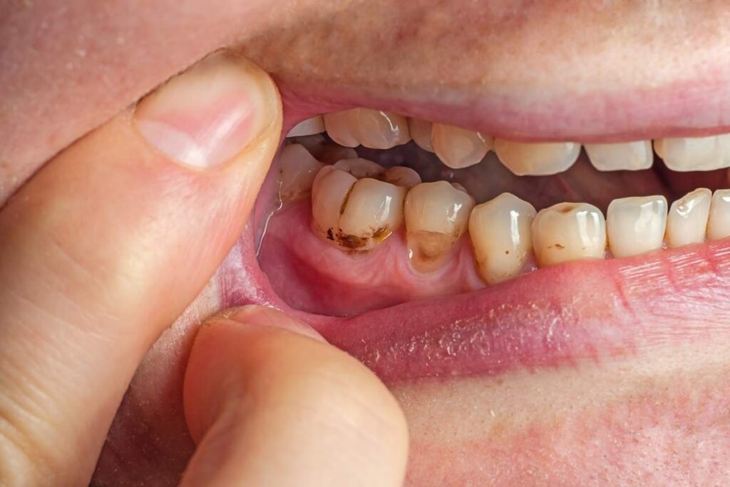 Dental plaque buildup on teeth near the gumline