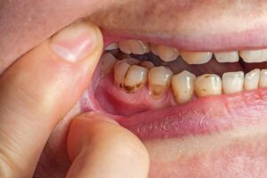 Dental plaque buildup on teeth near the gumline