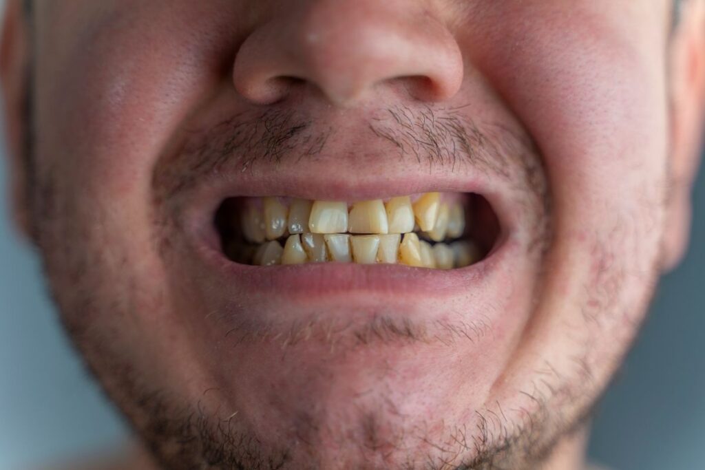 Dentists Treat Stubborn Tooth Stains That Whitening Can’t Fix