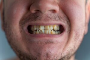 Dentists Treat Stubborn Tooth Stains That Whitening Can’t Fix